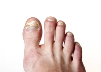 New Approaches in Identifying and Managing Onychomycosis